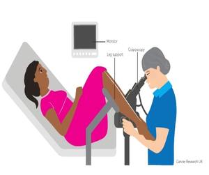 Colposcopy Test