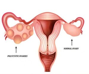 PCOD Treatment